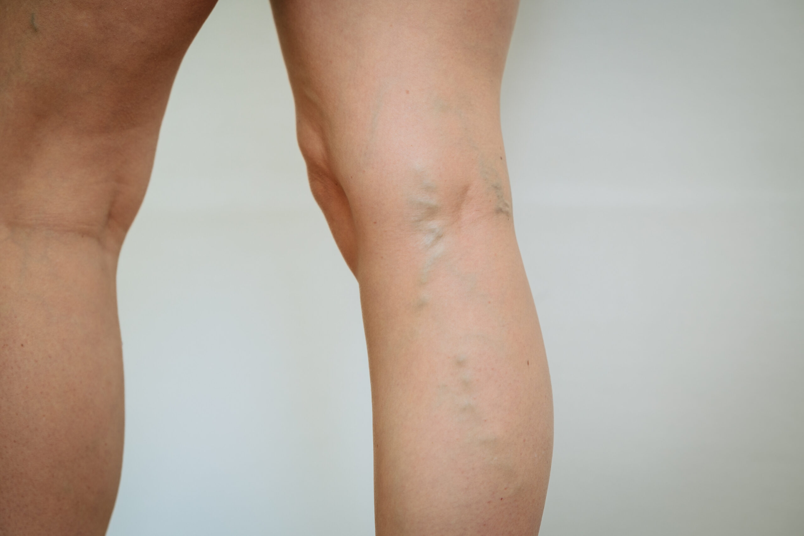 Ben med synliga åderbråck